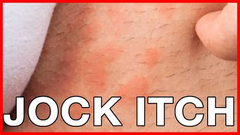 Jock Itch - Causes of Jock Itch in Women or Female - Treatment
