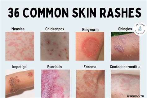 Rash: 36 Common Skin Rashes, Pictures, Causes &amp; Treatment