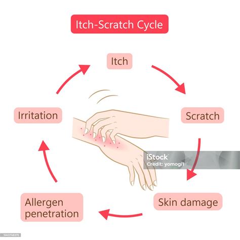 Itch Scratch Cycle Hands Illustration Dry Dermatitis And Atopic Eczema ...