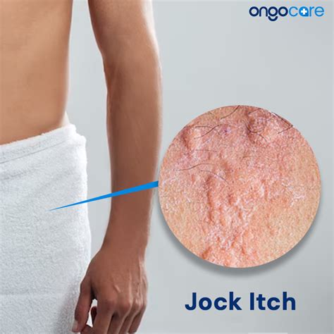 Jock Itch: Symptoms, Causes, Diagnosis, Treatment