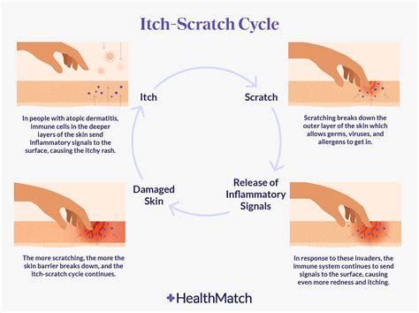 HealthMatch - More Than Itchy Skin: The Full Impact Of Living With Eczema