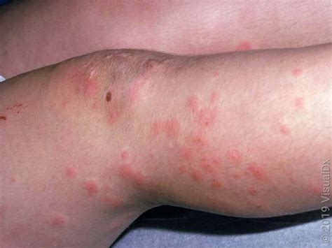 Swimmer’s Itch: Causes, Symptoms, and Treatment - GoodRx